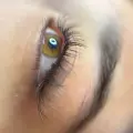کاشت مژه کلاسیک